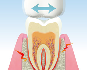 歯ぎしりの図