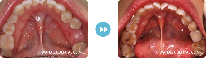 歯ぎしり・くいしばりが強いインプラント症例