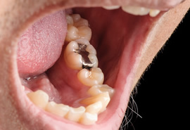 奥歯の銀歯の詰め物